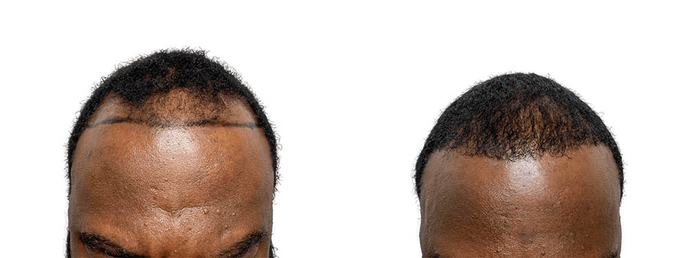 Hair Transplants Before & After Patient #615