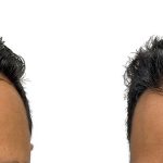 Hair Transplants Before & After Patient #597