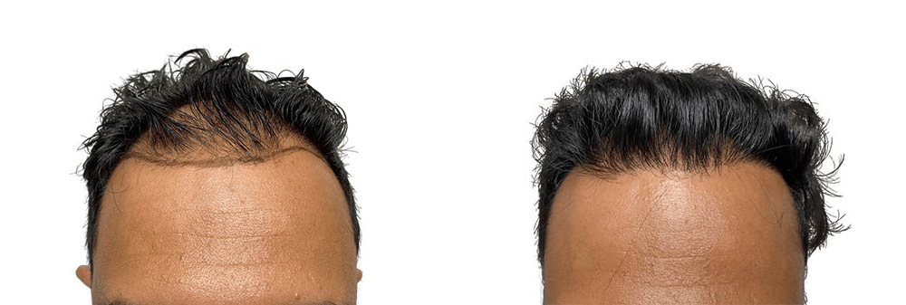 Hair Transplants Before & After Patient #597