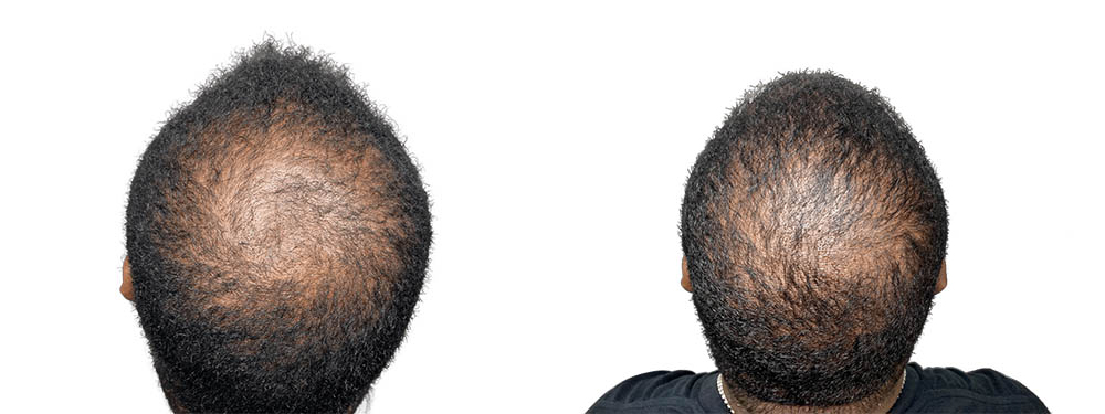 Hair Transplants Before & After Patient #615