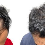 Hair Transplants Before & After Patient #597