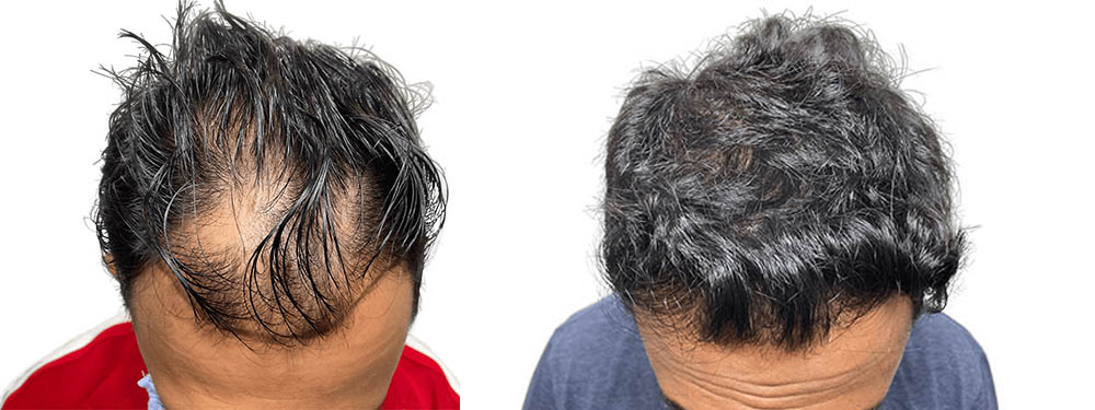 Hair Transplants Before & After Patient #597