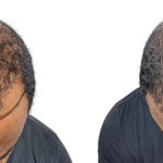 Hair Transplants Before & After Patient #615