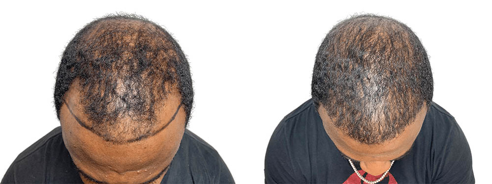 Hair Transplants Before & After Patient #615