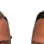 Hair Transplants Before & After Patient #620