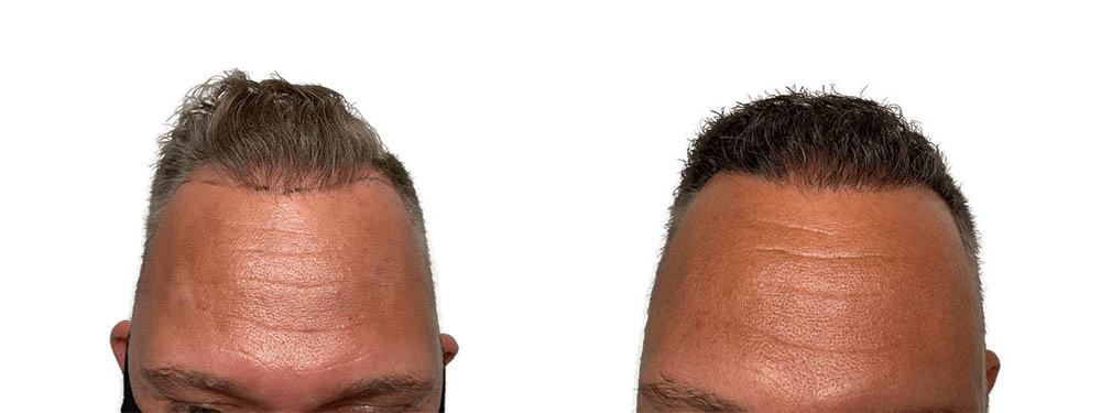 Hair Transplants Before & After Patient #620