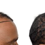 Hair Transplants Before & After Patient #600