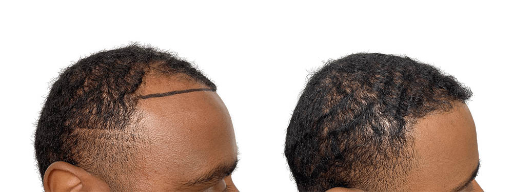 Hair Transplants Before & After Patient #600