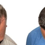 Hair Transplants Before & After Patient #620