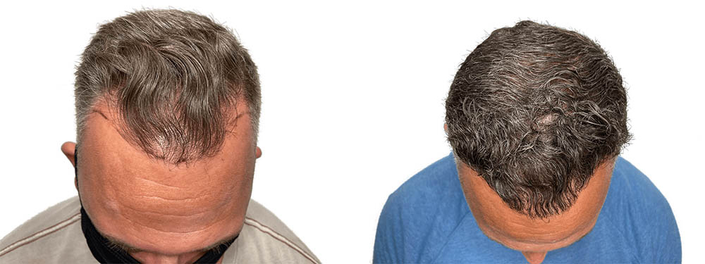 Hair Transplants Before & After Patient #620