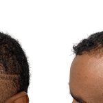 Hair Transplants Before & After Patient #600