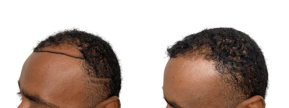 Hair Transplants Before & After Patient #600