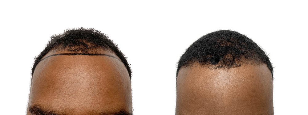 Hair Transplants Before & After Patient #600