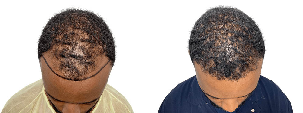 Hair Transplants Before & After Patient #600