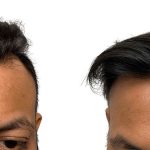 Hair Transplants Before & After Patient #623