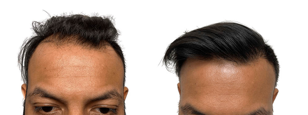 Hair Transplants Before & After Patient #623