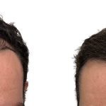 Hair Transplants Before & After Patient #605