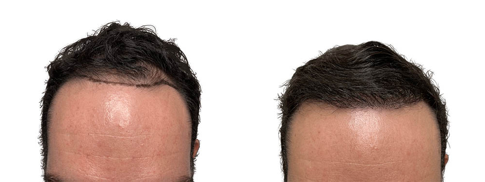 Hair Transplants Before & After Patient #605