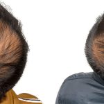 Hair Transplants Before & After Patient #623