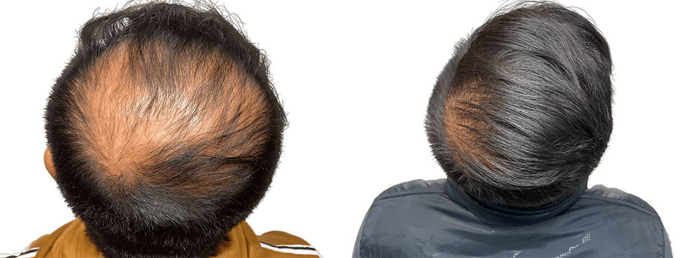 Hair Transplants Before & After Patient #623