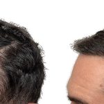 Hair Transplants Before & After Patient #605