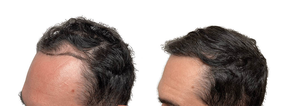 Hair Transplants Before & After Patient #605