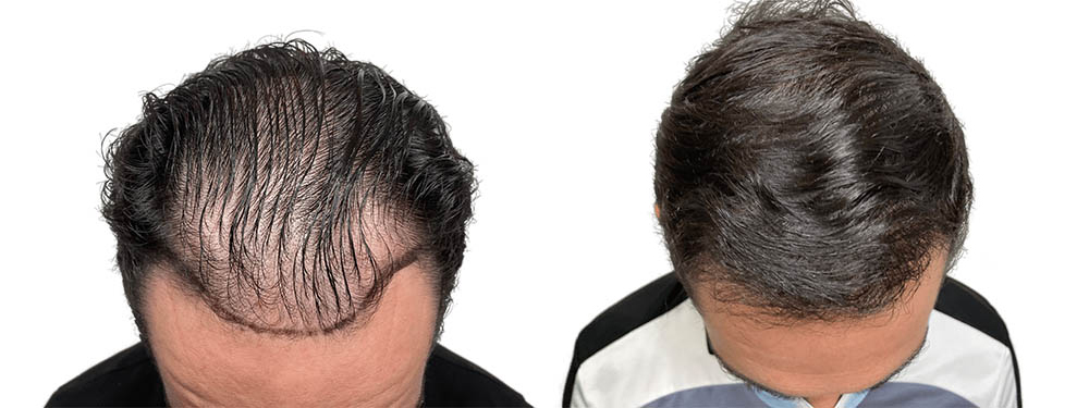 Hair Transplants Before & After Patient #605