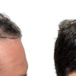 Hair Transplants Before & After Patient #605