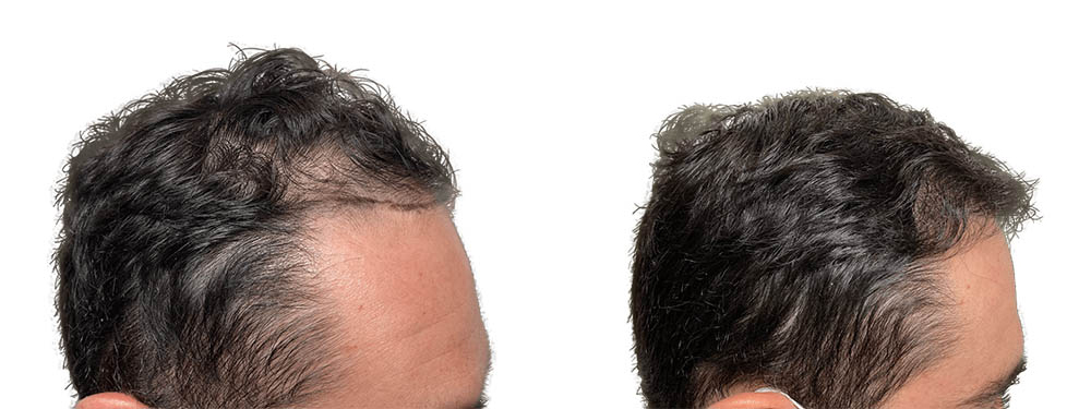 Hair Transplants Before & After Patient #605