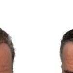 Hair Transplants Before & After Patient #626