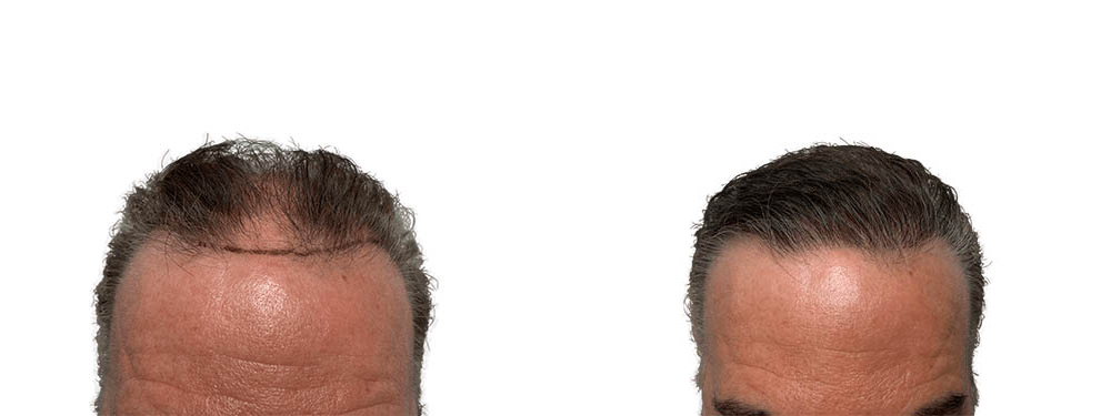 Hair Transplants Before & After Patient #626