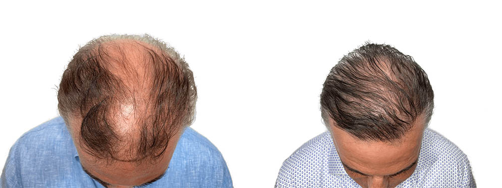 Hair Transplants Before & After Patient #626