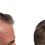 Hair Transplants Before & After Patient #626
