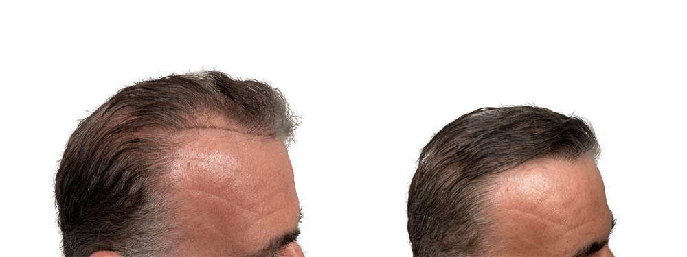 Hair Transplants Before & After Patient #626