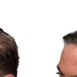 Hair Transplants Before & After Patient #626
