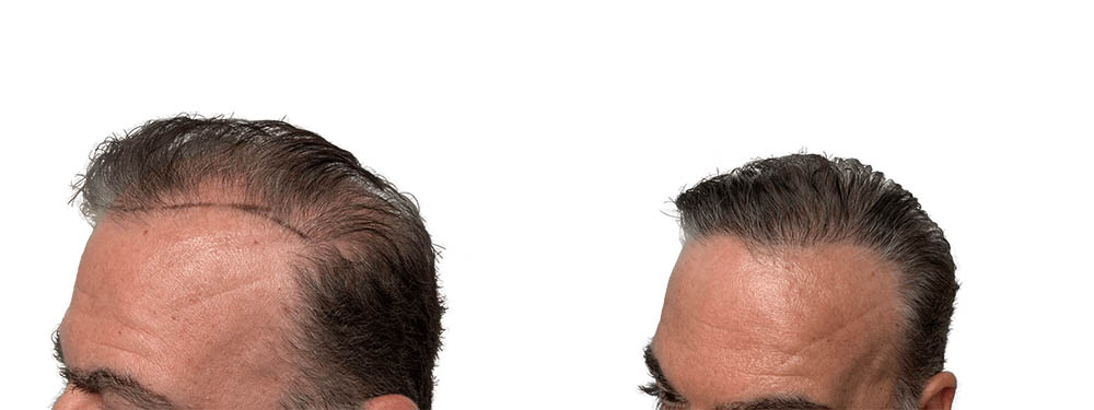 Hair Transplants Before & After Patient #626