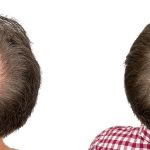 Hair Transplants Before & After Patient #631