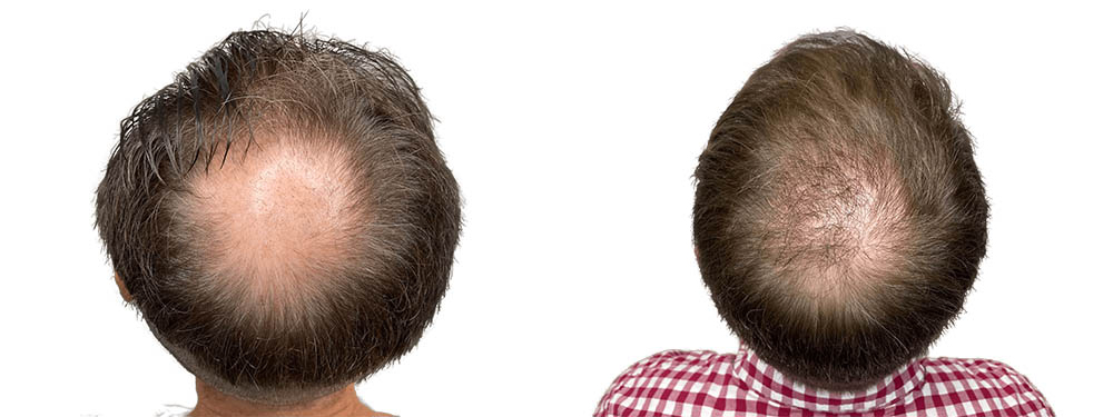 Hair Transplants Before & After Patient #631