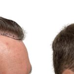 Hair Transplants Before & After Patient #631