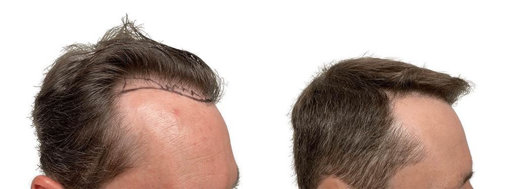 Hair Transplants Before & After Patient #631