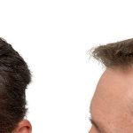 Hair Transplants Before & After Patient #631