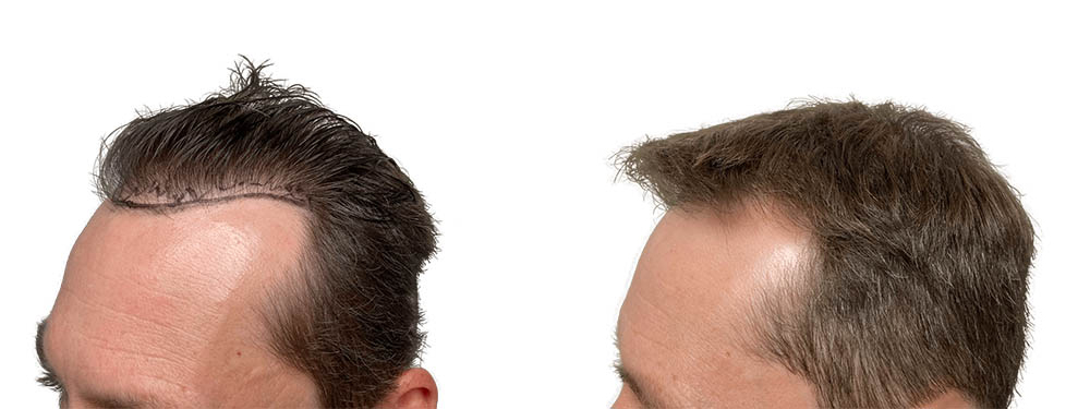 Hair Transplants Before & After Patient #631