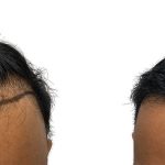 Hair Transplants Before & After Patient #635