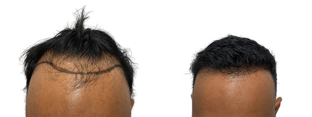 Hair Transplants Before & After Patient #635