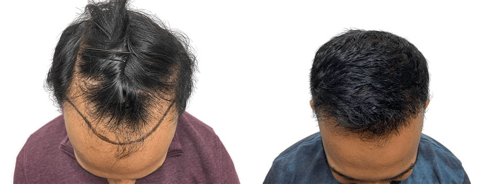 Hair Transplants Before & After Patient #635