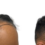 Hair Transplants Before & After Patient #635