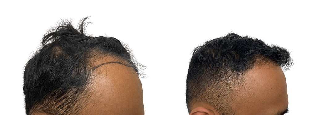 Hair Transplants Before & After Patient #635