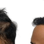 Hair Transplants Before & After Patient #635