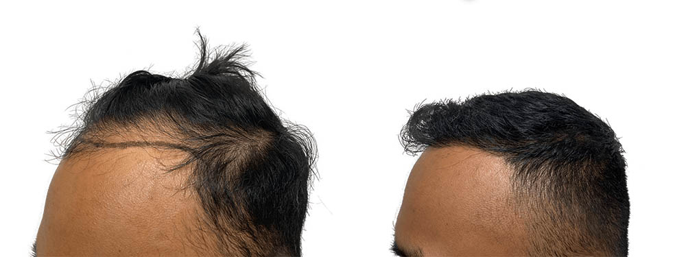 Hair Transplants Before & After Patient #635