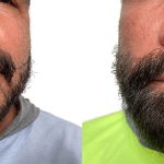 Hair Transplants Before & After Patient #640